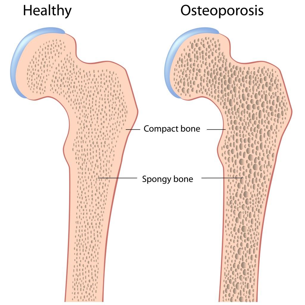 Osteoporosis Osteoporosis Diagnosis And Natural Treatments