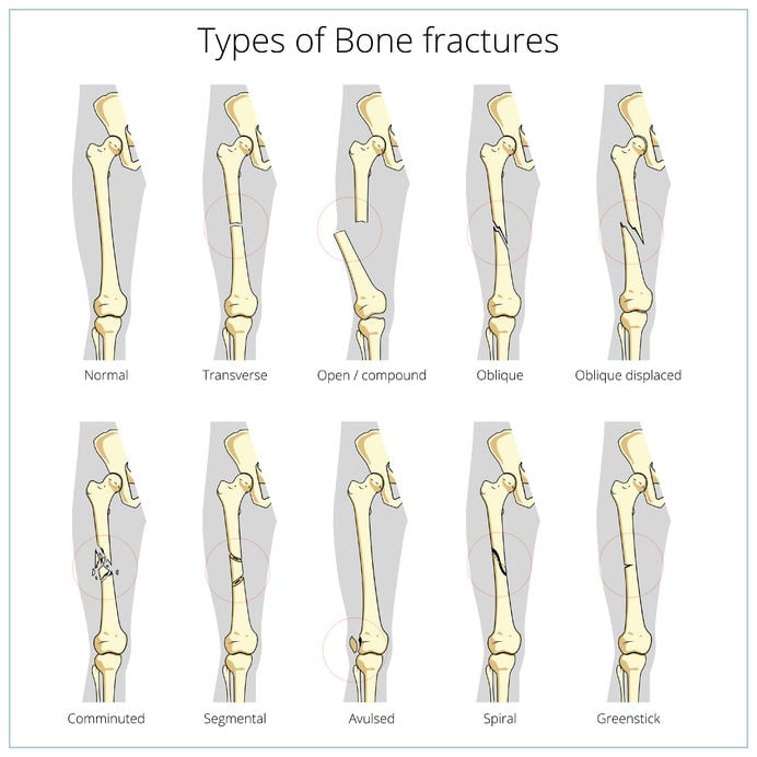 Bones Fractures - Types