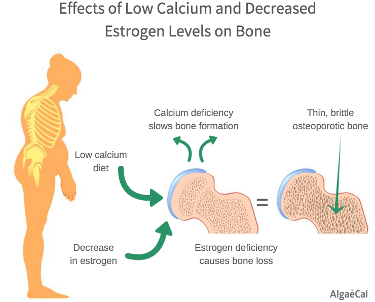 Everything You Need To Know About Postmenopausal Osteoporosis