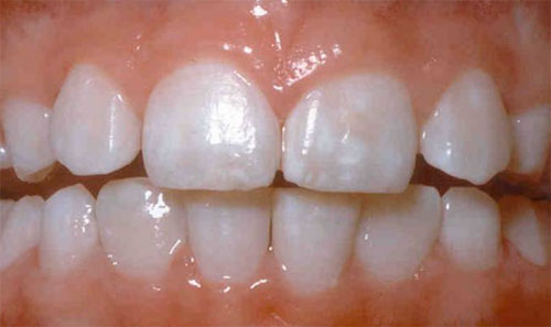 signs of fluorosis