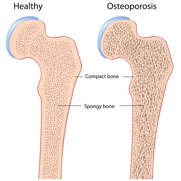 Osteoporosis in Men - Bone Density and Signs of Bone Loss