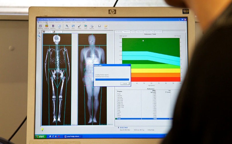 What are the effects of a bone marrow density scan?