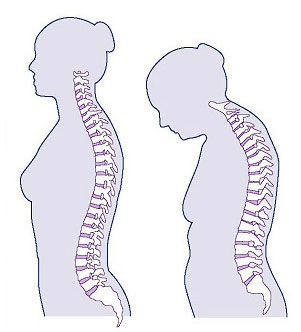 Discover The Best Natural Osteopenia Treatment