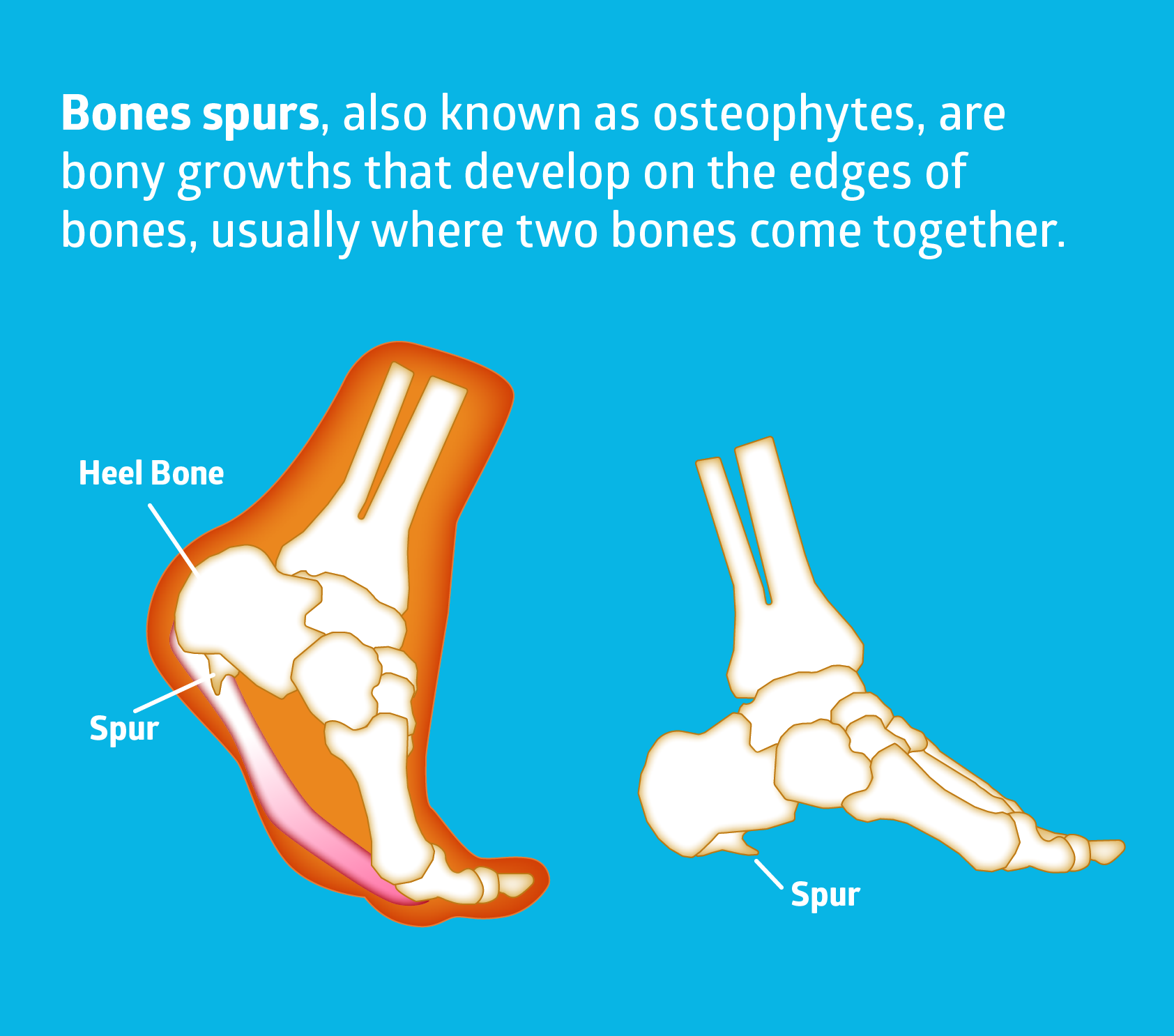 bone growth on foot