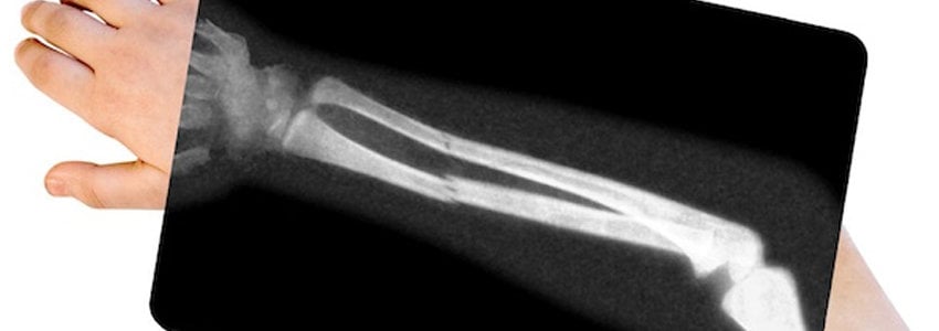 Understanding Bone Fractures