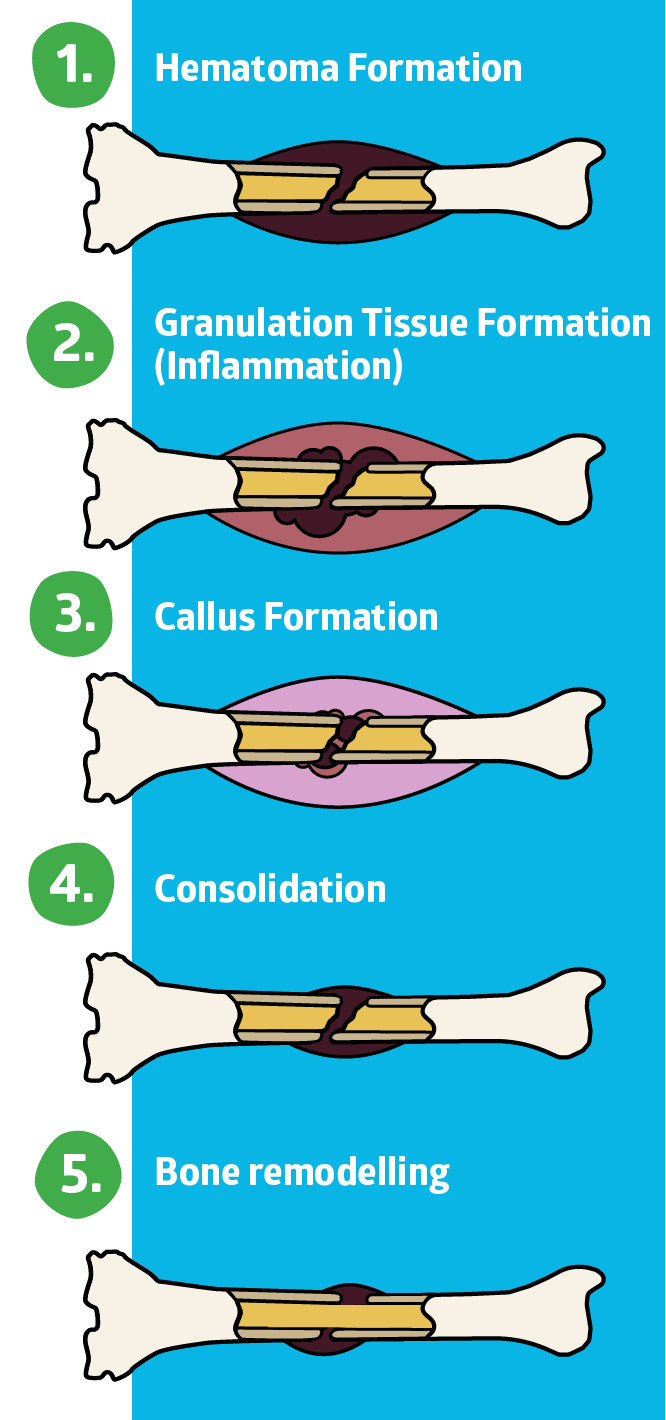 Best Vitamins To Help Heal Broken Bones - VitaminWalls